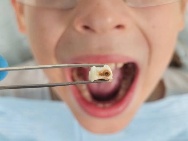 Best Emergency Tooth Extraction in Cutler, CA